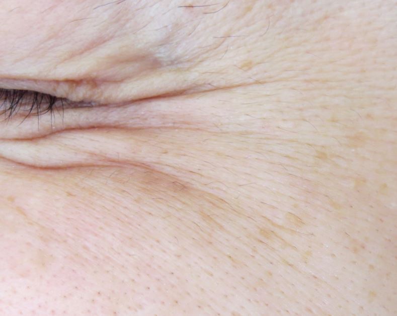 눈가주름 보톡스